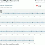 Fitbit Sense 1-Kanal EKG-Aufzeichnung
