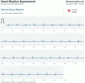 Fitbit Sense 1-Kanal EKG-Aufzeichnung