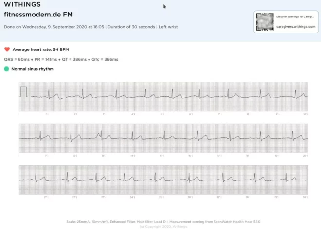 Withings ScanWatch: EKG-Bericht