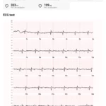 Polar Vantage V3 EKG Testergebnis PDF