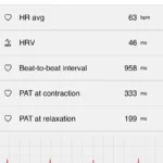 Polar Vantage V3 EKG Testergebnis